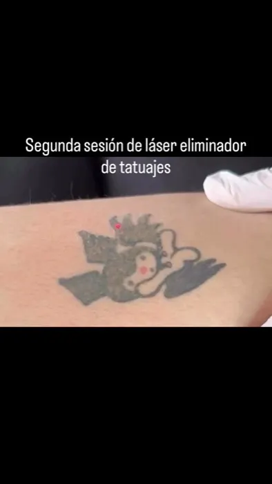 Remoción láser de tatuajes y pigmentos