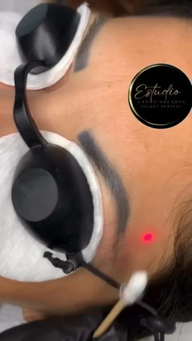 Eliminación de tatuaje en cejas